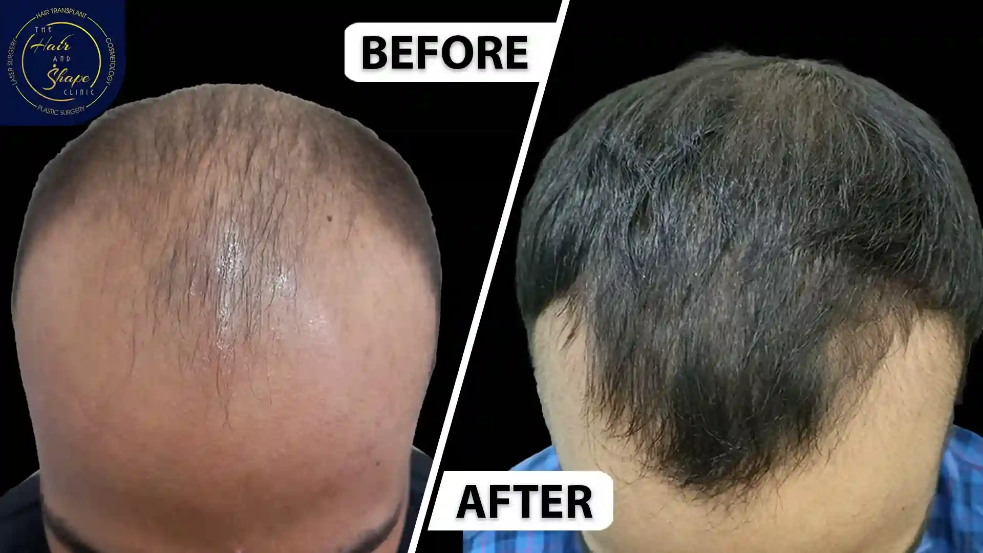 PRP Treatment result5